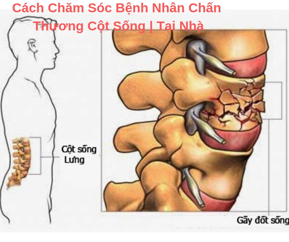 Chấn thương cột sống - Hình ảnh minh họa